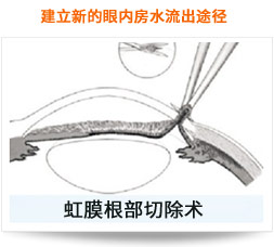 建立新的眼內房水流出途徑