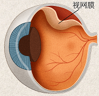 視網膜脫離