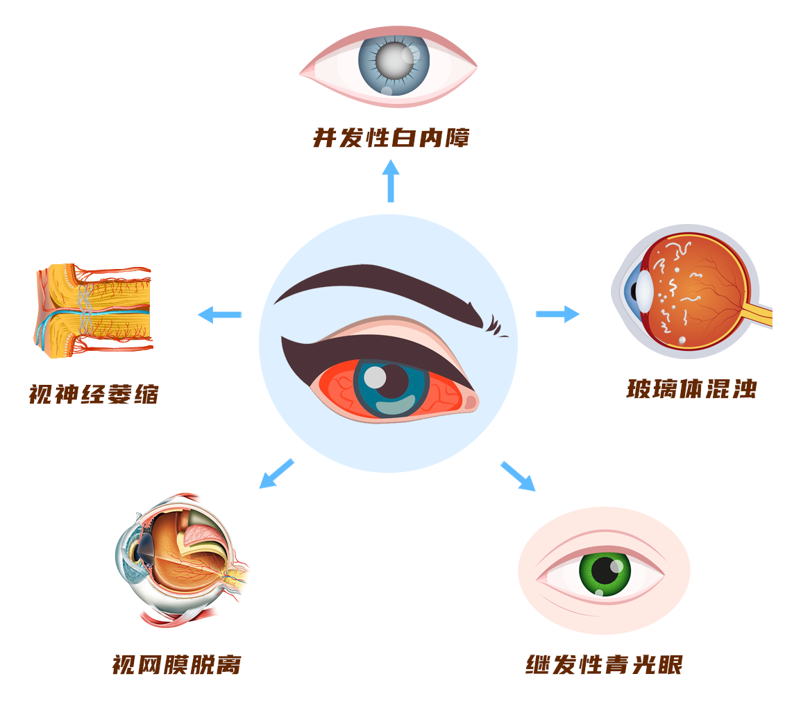 葡萄膜炎并發癥